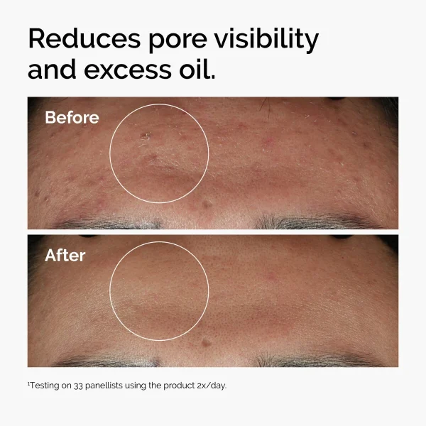 Niacinamide 10% + Zinc 1% - Image 4 Niacinamide 10% + Zinc 1%